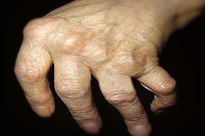 reumatoidinis artritas kineziterapija petį sąnarių skausmas po sužeidimo