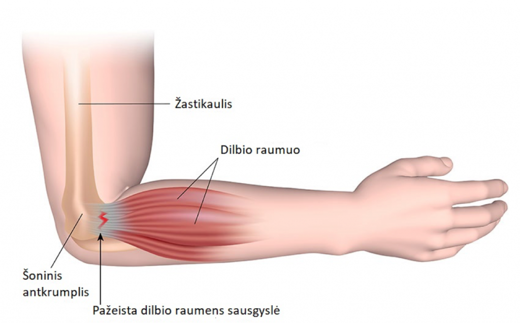 skauda rankos venas gydymas artritas iš pirštų galų gydymo sąnarių