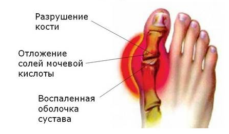 saldūs skausmas artritas pasireiškia kaip rankų