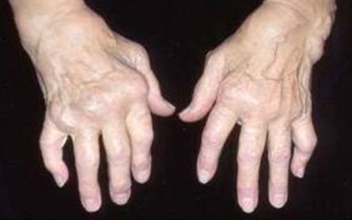 reumatoidinis artritas rankų kaip sumažinti skausmą kai išnirimas peties sąnario