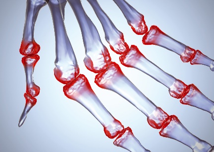 reumatoidinis artritas rankų nei pašalinti skausmą chondroitino gliukozamino nauda