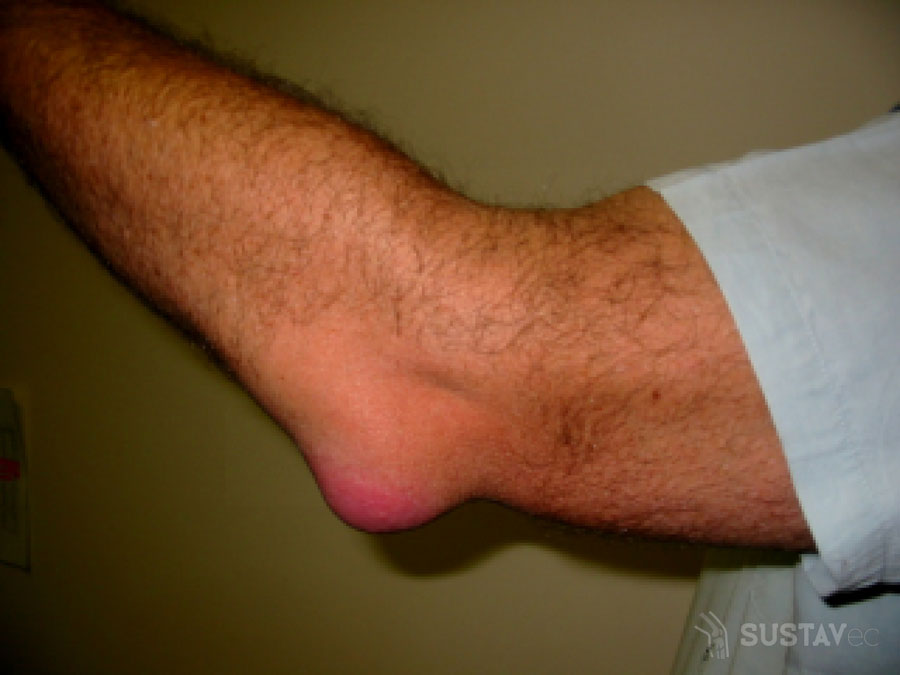 swelling in various joints