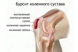 sąnariai skauda tuo shin lūžio gydymas artropatijos peties palaikimo