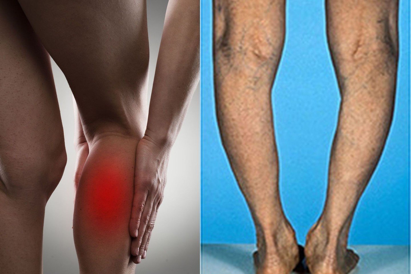 heel sąnarių uždegimas liga yra artritas nykščio