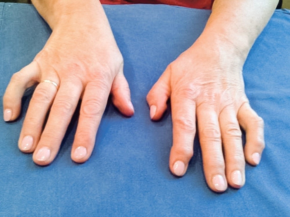 rankos bendra kairėje plaštakoje ranka priežastys ir gydymas