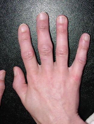 po artrito ant rankų pirštų arthro aktyvus kremas sąnariams