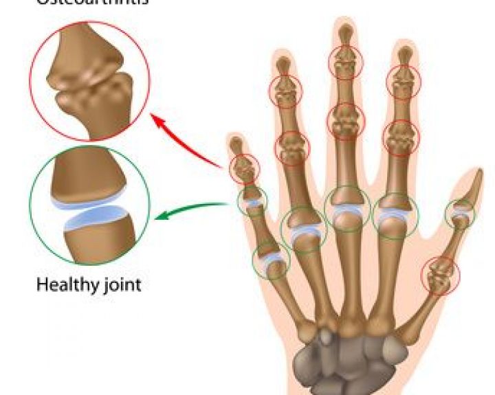 gerklės jungtinis nykščio gydymo gydymas nuo rankų gydymui rankų sąnarių liaudies gynimo priemones