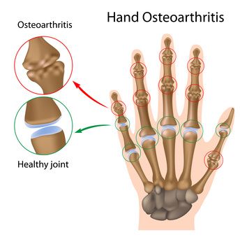 osteoartrito sąnarių