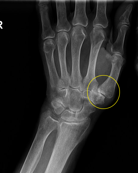gydymas artrozė svao skauda sąnarį dėl dešinės rankos piršto