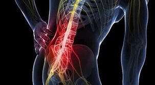 liaudies metodai gydant artrozė pirštus osteochondrozė gydymas sukelia liaudies gynimo