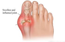 swollen painful toe joints tempimo tepalas alkūnę