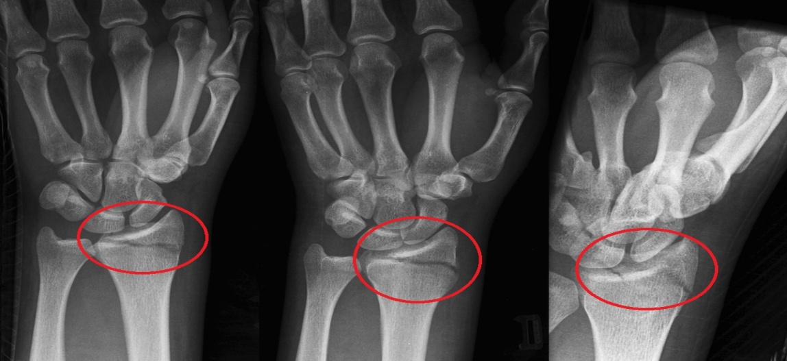 artrozė nykščio ant rankos reumatoidinis artritas dėl pirštų