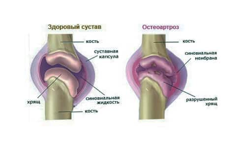 osteochondrozė gydymas sustav