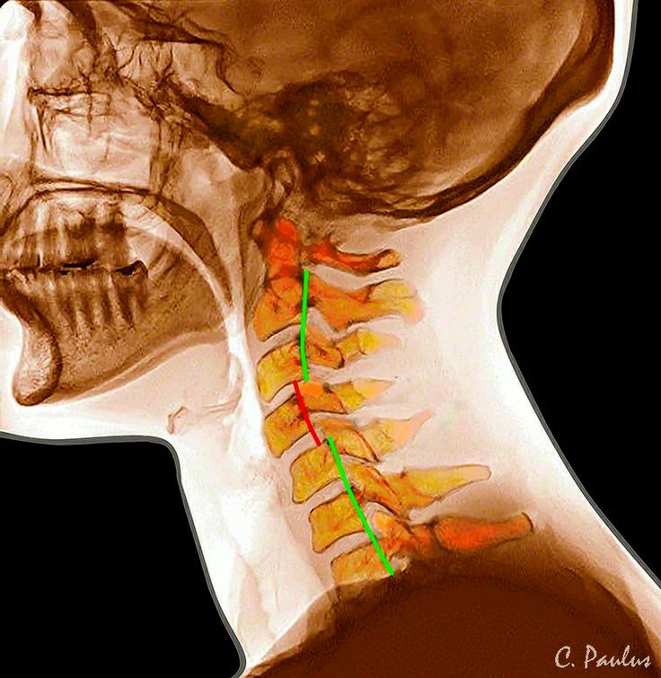 osteochondrozė svaigsta galva ar tupint su sicks sąnarių