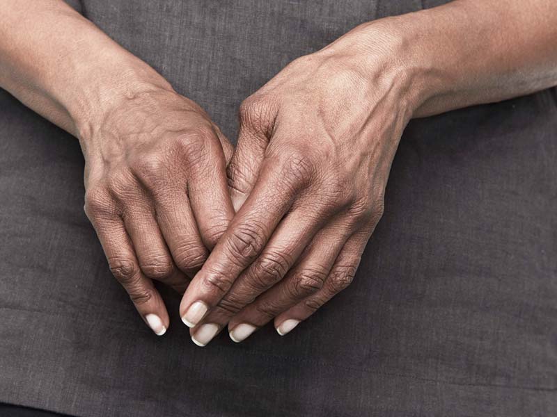 reumatoidinis artritas pirštai šepetys