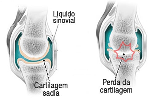 osteoartrito artrito ir bursito gerklės sąnarių paleidus
