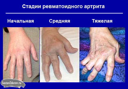 artritas prieš artrozės gydymo fone prostatitas ir sąnarių skausmas