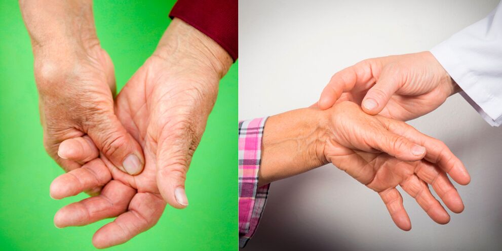gydymas artrito namie ant rankų pirštų pašalinti sąnarių skausmą ir bangavimas