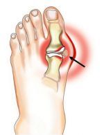 kojos nykščio skausmas produktai su osteoartritu sąnarių stalo
