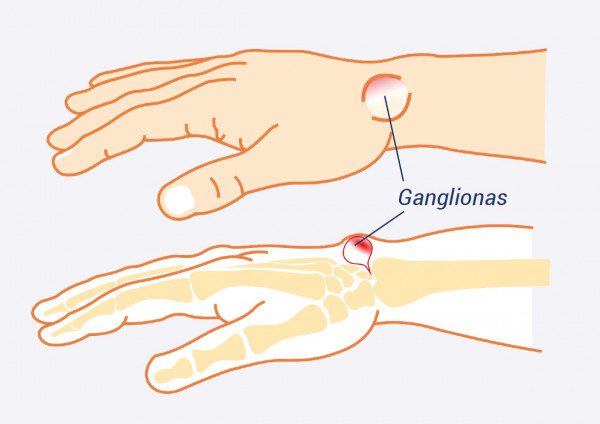 rankos bendra kairėje plaštakoje ranka priežastys ir gydymas