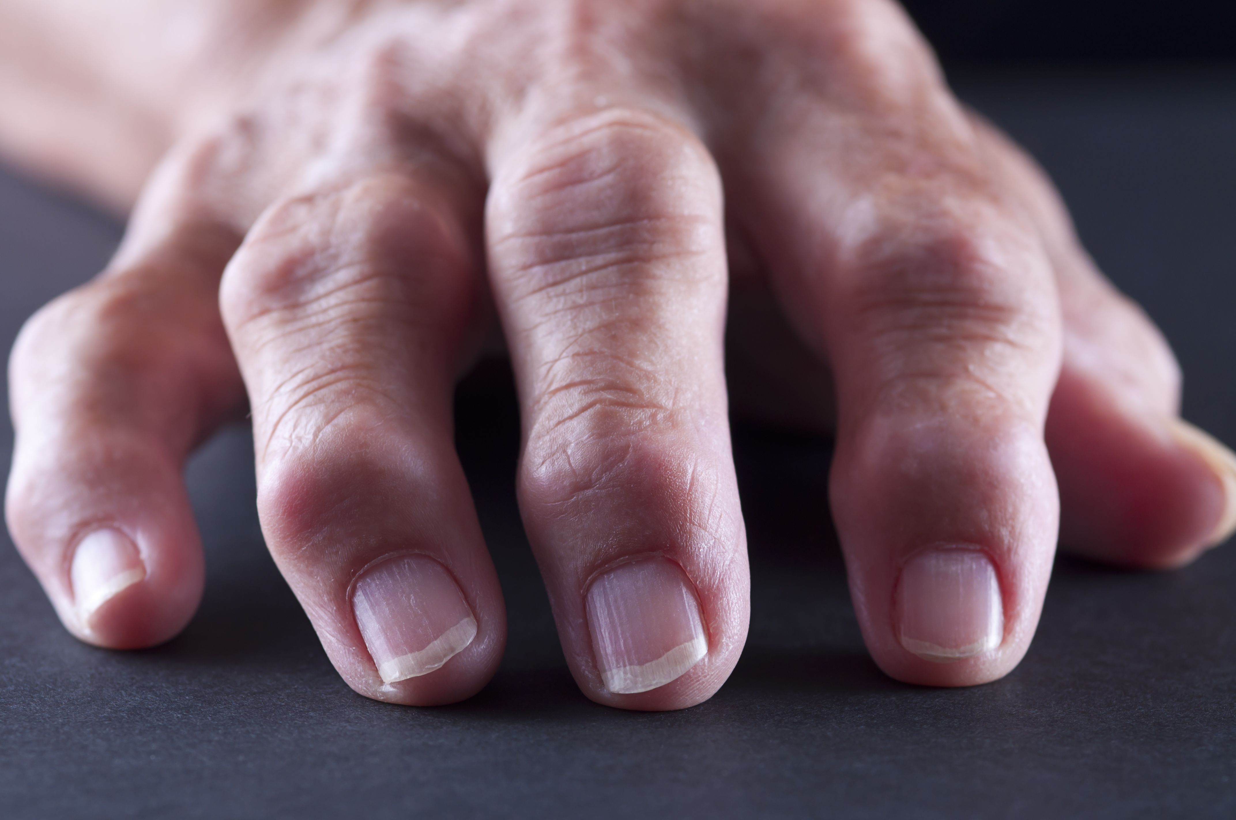 swelling painful joints in fingers and toes