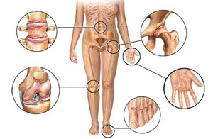 artritas arba artrito simptomų esantys rankų