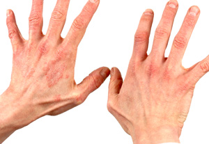 rankų pirštų liga gydymas artrozės