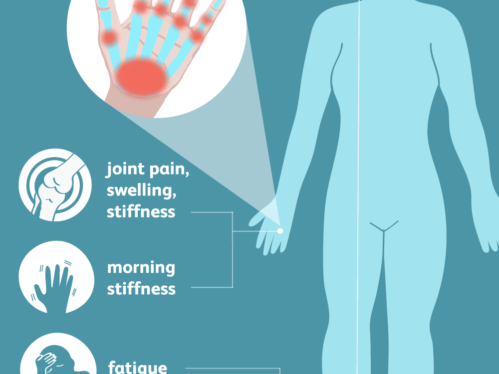 edema with joint pain priemonės skirtos pirštų sąnarių gydymo