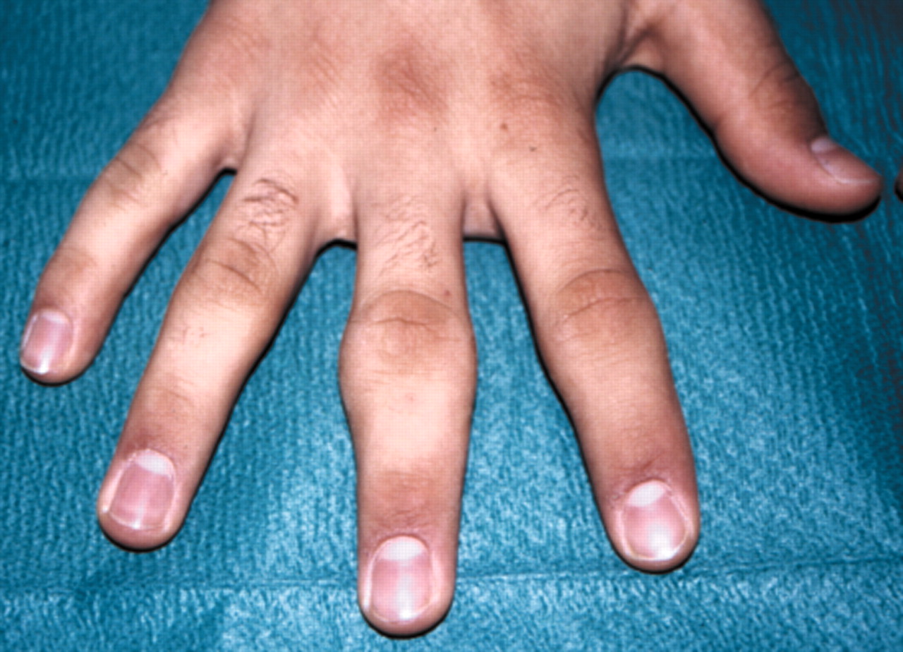 swollen painful knuckle joints kaip gydyti sąnarius pagal liaudies gynimo