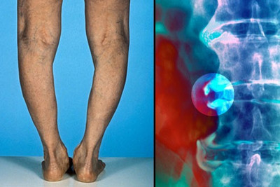 osteoartrito pėdos gydymas