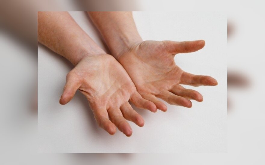 artritas rankas kas tai yra