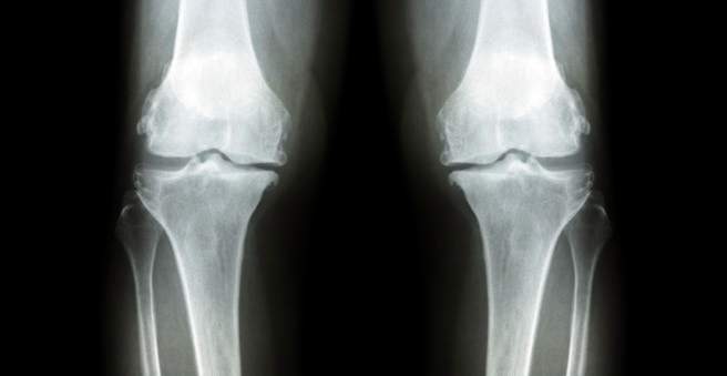osteoartrito peties sąnario pasekmės