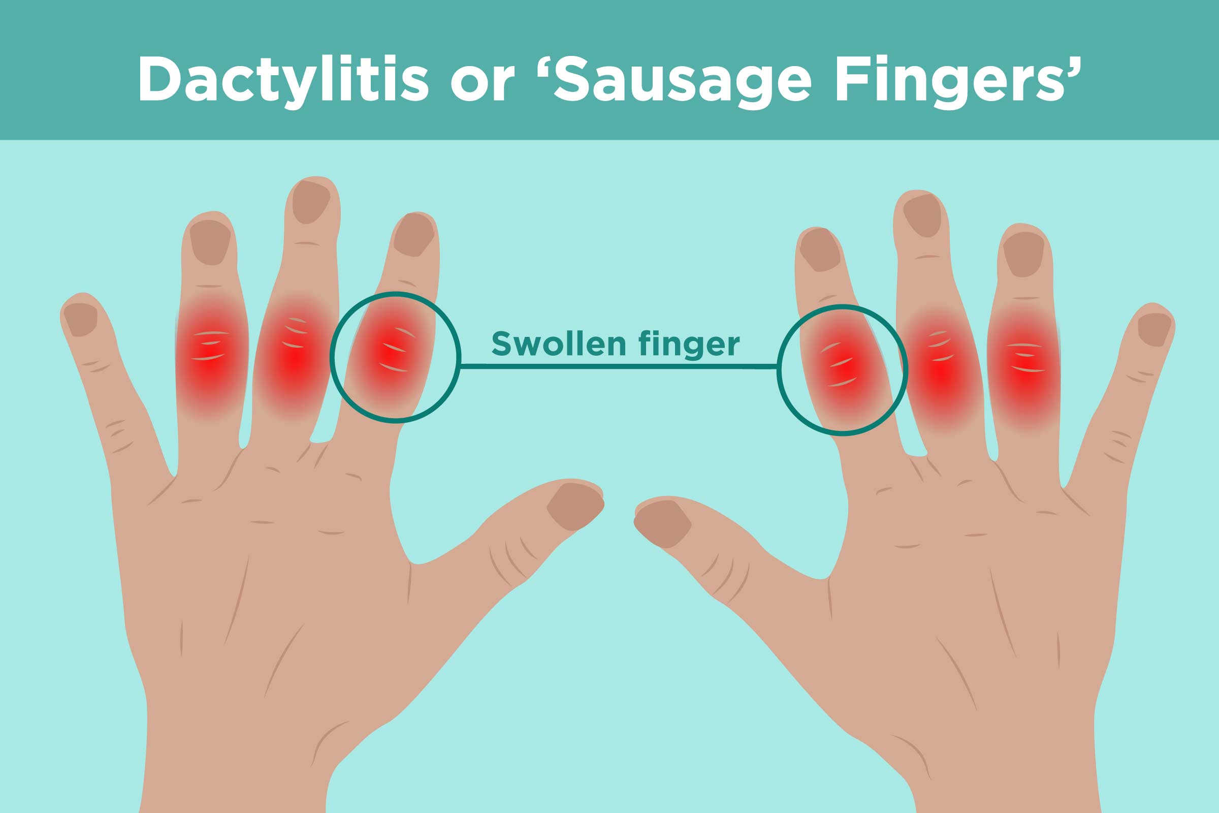 swelling in finger joints without pain