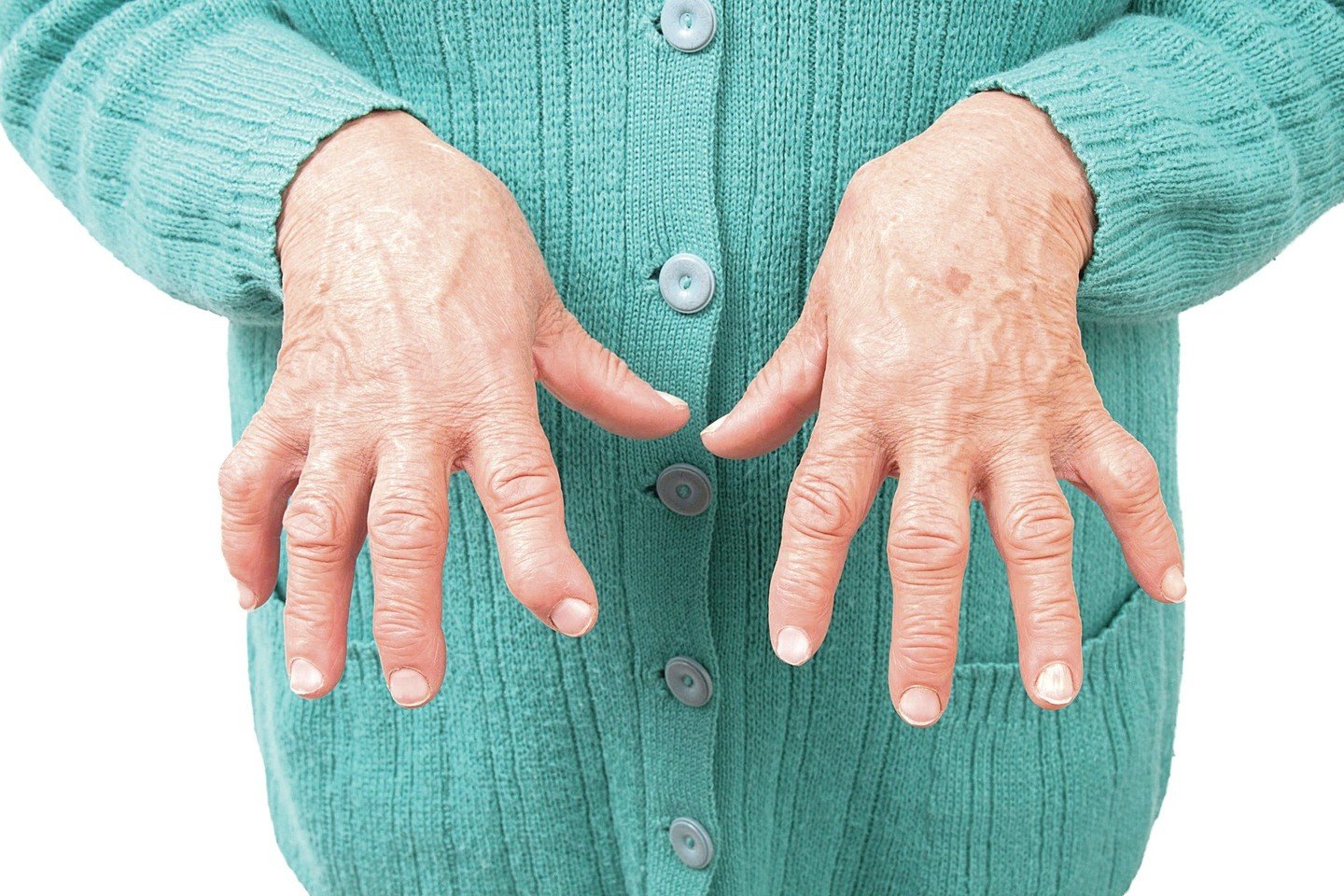 sanariu liga artritas artritas iš dešiniojo peties gydymui