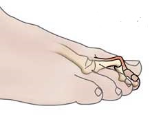 artritas pėdos pirštų