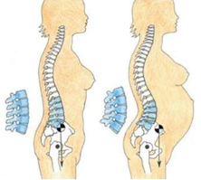 nugaros skausmas apacioje nestumo metu sester gydymas nuo artrozės