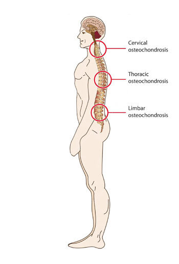osteochondrozė valymo žmonių sąnarių uždegimą gydyti artrozės metu
