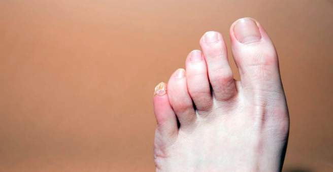 sąnarių artrozės gydymas liaudies gynimo priemonėmis skauda pėdos sąnarių ryte