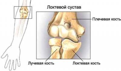 artrozė arba nykščio artritas gydymas artrozės 2 3 laipsnių