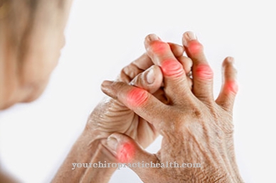 gydymas sąnarių ligomis artritas artrozė skirtumai ir metodai gydymas