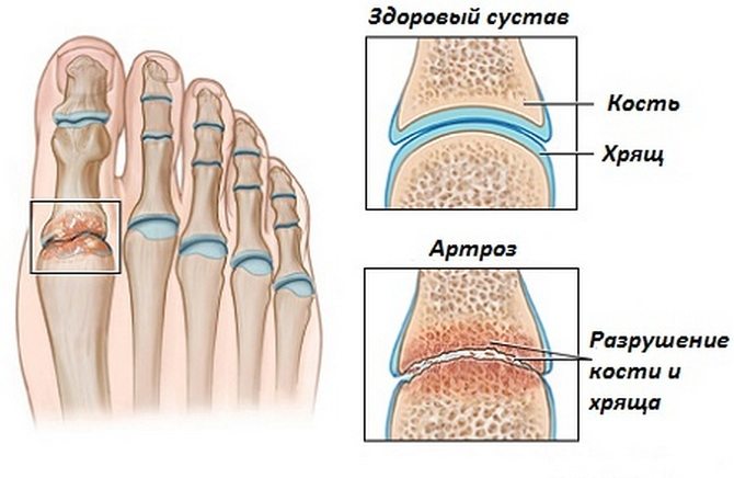 reumatoidinis artritas dėl pėdos sąnarių gydymo gydymas pečių osteoartrito
