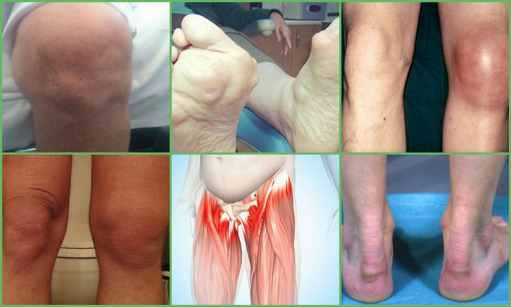 gydymas artrozės ir pėdų sąnarių liaudies gynimo priemones