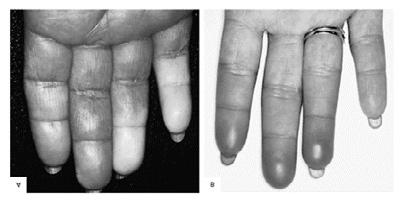 artritas rankų valymo tepalas gelis artritas artrozė sultys gydymas