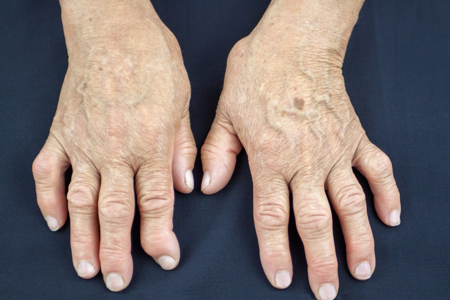 įrankiai nuo peties sąnario artrozės skauda sąnarius iš tempimo