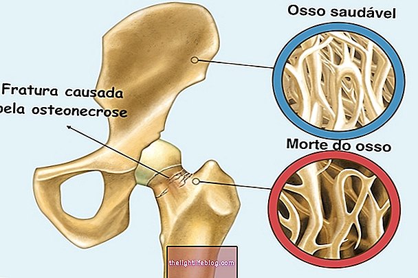 tepalas su osteochondroze žindymo metu