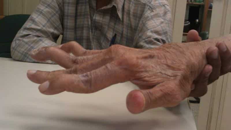 artritas prieš artrozės gydymo fone tradicinių gydymo metodai artrito alkūnės