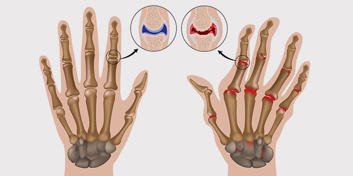 artrito šepečio rankų gydymo nikofleks tepalas nuo osteochondrozės