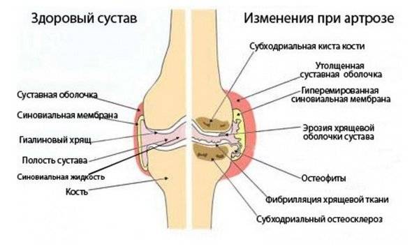 artrozė apdorojimo sistema