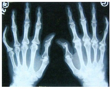 artrozė arba artrito gydymo rankų ligos pėdos sąnarių ir jų gydymas