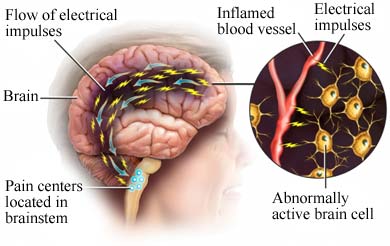 artrozė ir jo migrena gydymas